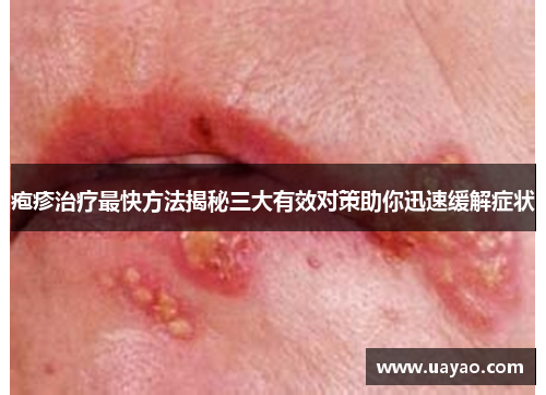 疱疹治疗最快方法揭秘三大有效对策助你迅速缓解症状